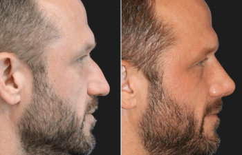 45 year-old male before and 4 weeks after rhinoplasty and septoplasty combination