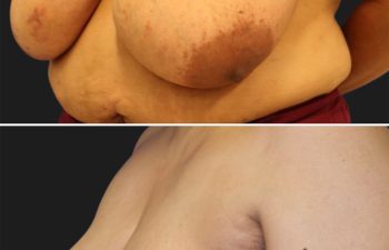 55 year-old patient before and 4 months after a breast reduction.