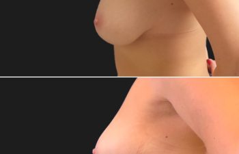 48 year-old patient before and after breast reduction.
