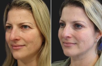 47 year-old before and after Eyelid Surgery (Upper) and Crow's Feet Botox