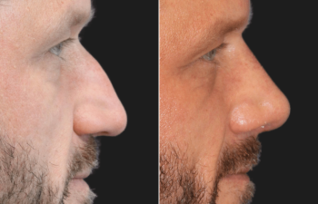 45 year-old before and 4 weeks after rhinoplasty and septoplasty