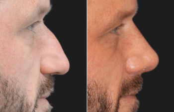 45 year-old male before and 4 weeks after rhinoplasty and septoplasty combination