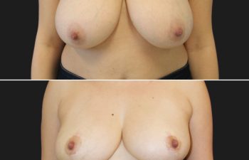42 year-old before and 10 months after breast reduction