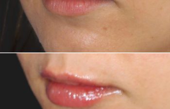 29 year-old before and after 4.1 ml of filler in the chin, jawline, cheeks, lips, and under-eyes.