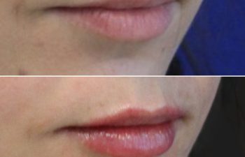 29 year-old before and after 4.1 ml of filler in the chin, jawline, cheeks, lips, and under-eyes.