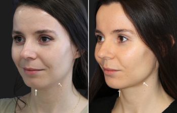 29 year-old before and after 4.1 ml of filler in the chin, jawline, cheeks, lips, and under-eyes.