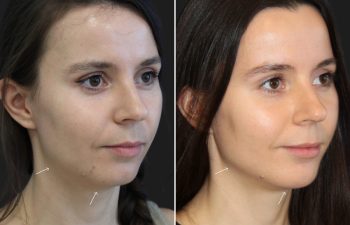 29 year-old before and after 4.1 ml of filler in the chin, jawline, cheeks, lips, and under-eyes.