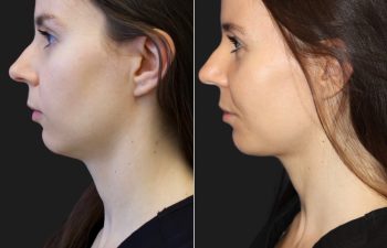 29 year-old before and after 4.1 ml of filler in the chin, jawline, cheeks, lips, and under-eyes.