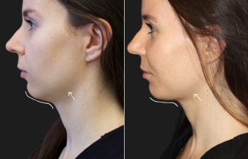 29 year-old before and after 4.1 ml of filler in the chin, jawline, cheeks, lips, and under-eyes.