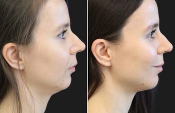 29 year-old before and after 4.1 ml of filler in the chin, jawline, cheeks, lips, and under-eyes.