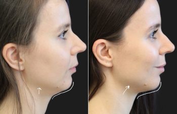 29 year-old before and after 4.1 ml of filler in the chin, jawline, cheeks, lips, and under-eyes.