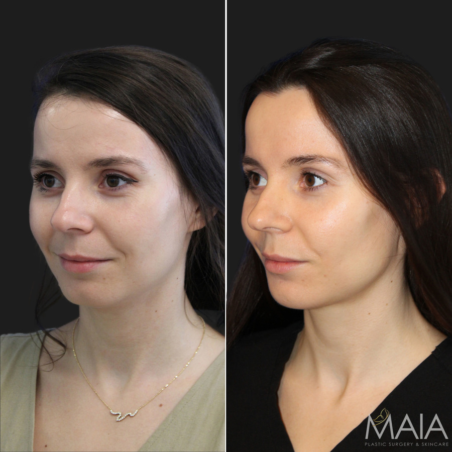 🥇 Liposuction  Maia Plastic Surgery