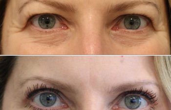 47 year-old before and after Eyelid Surgery (Upper) and Crow's Feet Botox