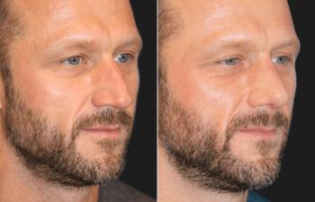 45 year-old before and 4 weeks after rhinoplasty and septoplasty