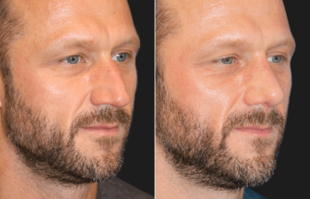 45 year-old male before and 4 weeks after rhinoplasty and septoplasty combination