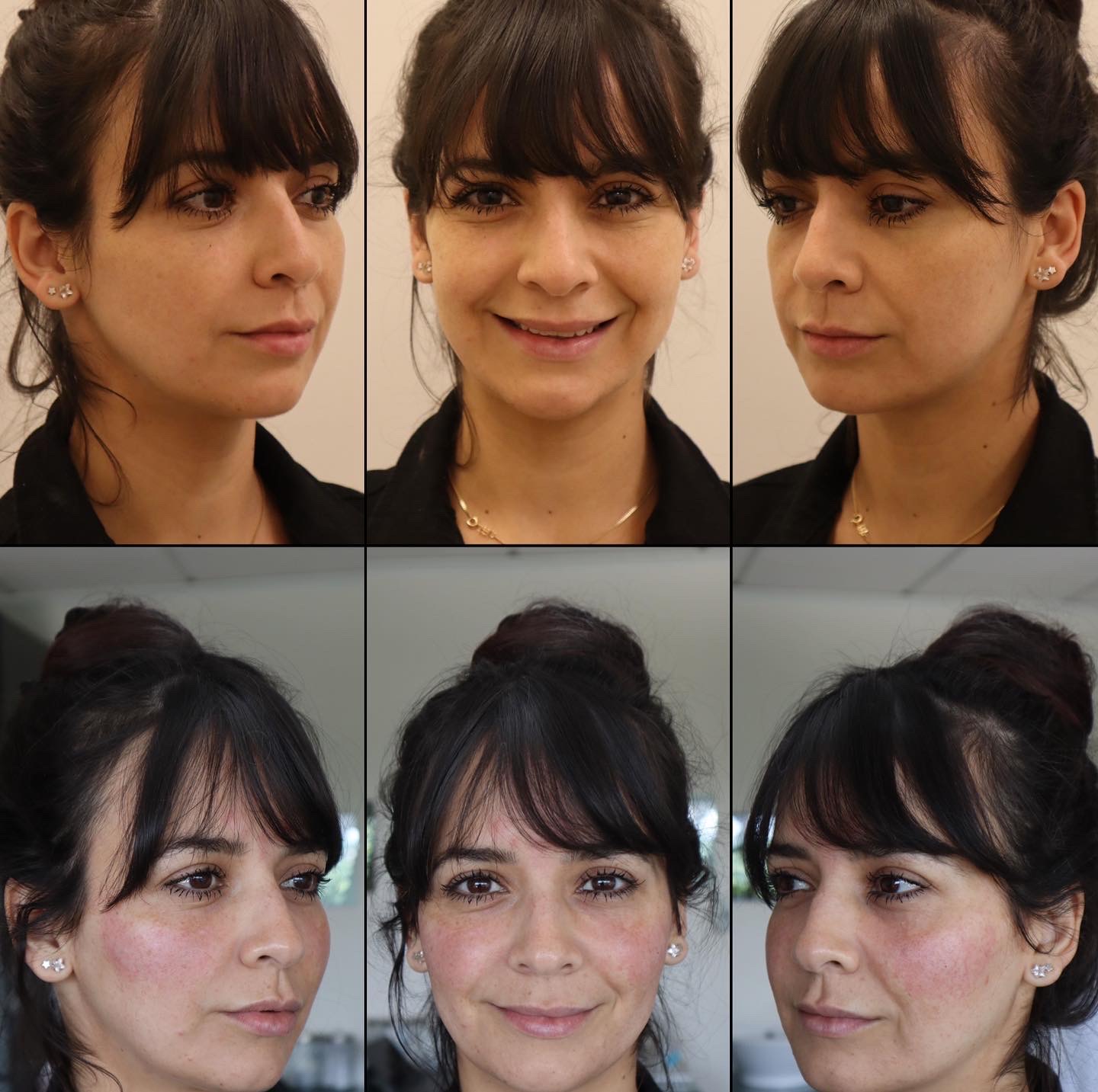 36 year-old female before and after cheek filler (Web ID #1341)2