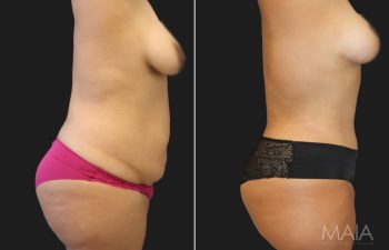 36 year-old mother of 2 before and 5 months after a tummy tuck with a hernia repair, liposuction of flanks and lower back, and a breast lift.