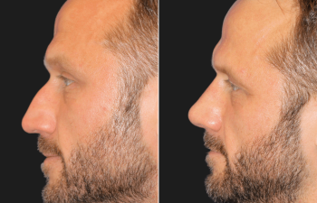 45 year-old before and 4 weeks after rhinoplasty and septoplasty