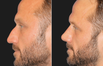 45 year-old male before and 4 weeks after rhinoplasty and septoplasty combination