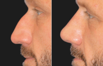 45 year-old before and 4 weeks after rhinoplasty and septoplasty