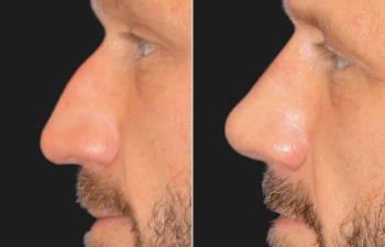 45 year-old male before and 4 weeks after rhinoplasty and septoplasty combination