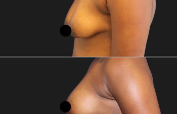 patient before and after breast lift with augmentation