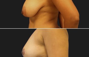 48 year-old before and after a breast reduction