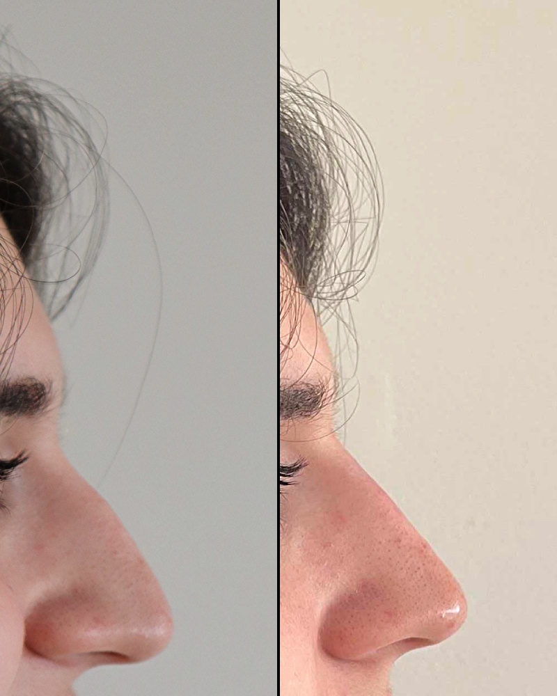 17 year-old before and after non-surgical rhinoplasty