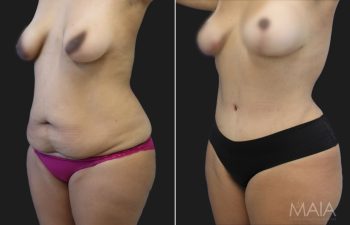 36 year-old mother of 2 before and 5 months after a tummy tuck with a hernia repair, liposuction of flanks and lower back, and a breast lift.