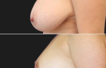 42 year-old before and 10 months after breast reduction