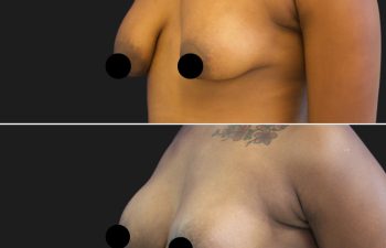 patient before and after breast lift with augmentation