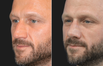 45 year-old before and 4 weeks after rhinoplasty and septoplasty