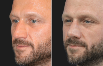 45 year-old male before and 4 weeks after rhinoplasty and septoplasty combination