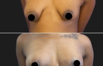 patient before and after breast lift with augmentation