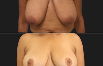 59 year-old before and after a breast reduction. before and after photo