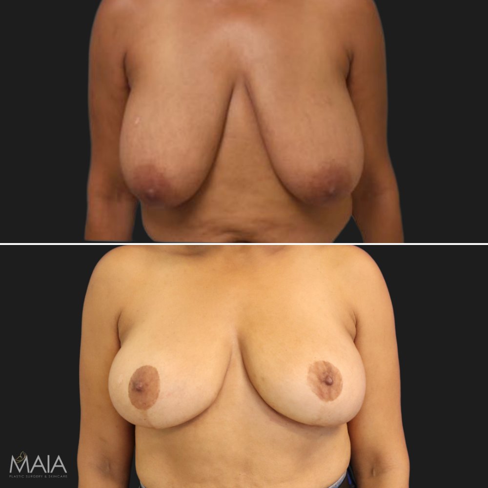 59 year-old before and after a breast reduction. before and after photo