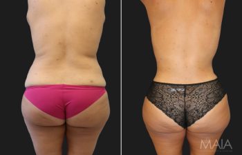 36 year-old mother of 2 before and 5 months after a tummy tuck with a hernia repair, liposuction of flanks and lower back, and a breast lift.