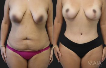 36 year-old mother of 2 before and 5 months after a tummy tuck with a hernia repair, liposuction of flanks and lower back, and a breast lift.