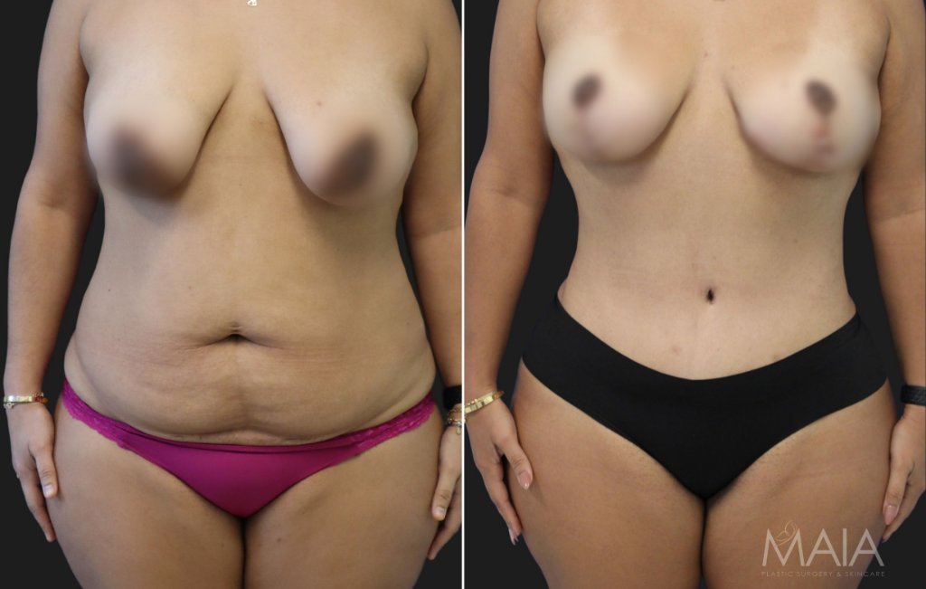 36 year-old mother of 2 before and 5 months after a tummy tuck with a hernia repair, liposuction of flanks and lower back, and a breast lift.