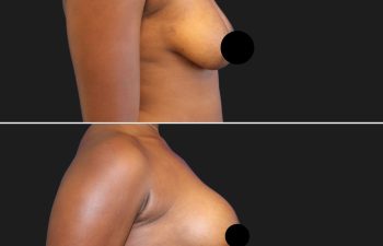 patient before and after breast lift with augmentation