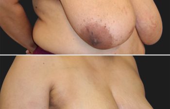 55 year-old patient before and 4 months after a breast reduction.