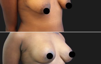 patient before and after breast lift with augmentation