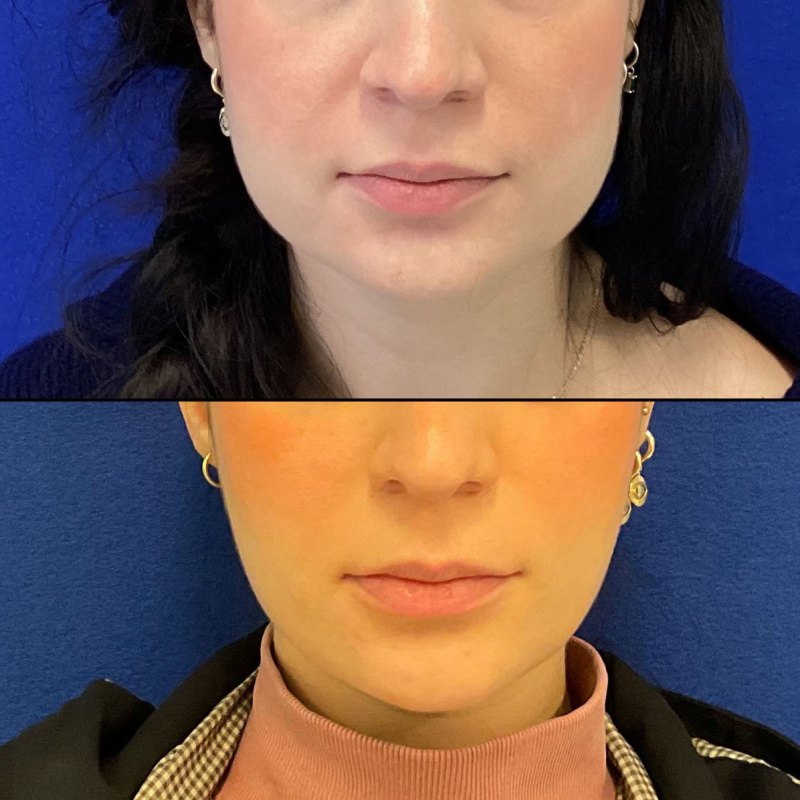 31 year-old patient before and after masseter botox