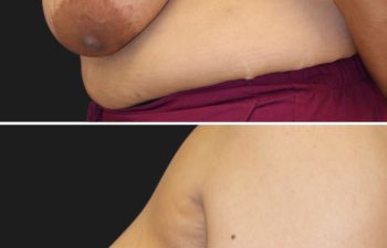 55 year-old patient before and 4 months after a breast reduction.