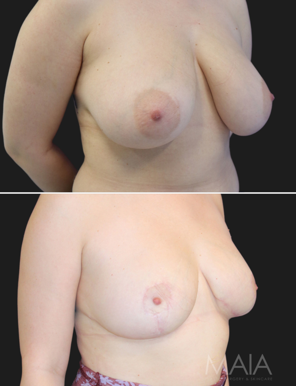 31 year-old patient before and 6 months after a breast reduction
