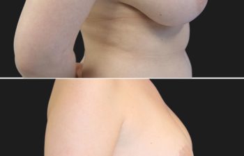 31 year-old patient before and 6 months after a breast reduction