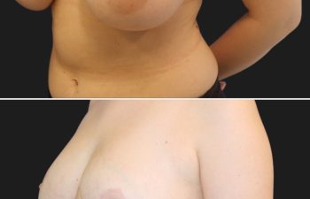 31 year-old patient before and 6 months after a breast reduction