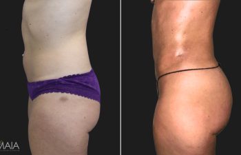35 year-old patient before and after liposuction of the abdomen, flanks, and fat transfer to the buttocks. Not pictured: Fat transfer to the breasts.