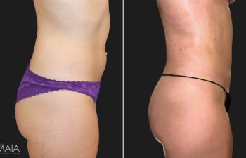 35 year-old patient before and after liposuction of the abdomen, flanks, and fat transfer to the buttocks. Not pictured: Fat transfer to the breasts.