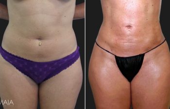 35 year-old patient before and after liposuction of the abdomen, flanks, and fat transfer to the buttocks. Not pictured: Fat transfer to the breasts.